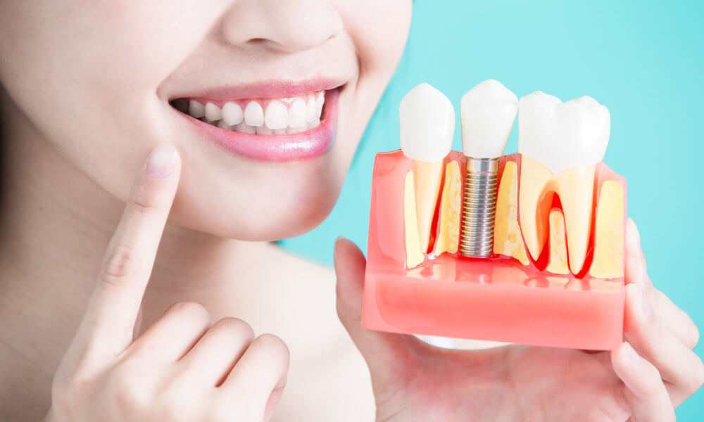 Woman showing a display of dental implants in anchorage